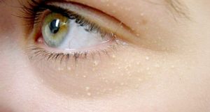 xantelasma