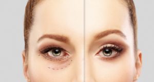 blefaroplastia