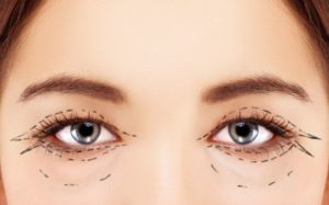 pos-operatorio-da-blefaroplastia