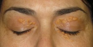 xantelasma