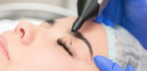como e feita a blefaroplastia sem cortes