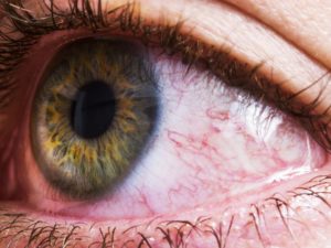 vermelhidão ocular