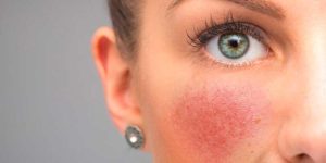 rosacea