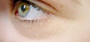 xantelasma