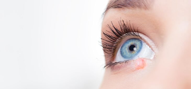 Terçol é lesão inflamatória palpebral mais comum