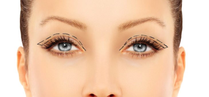 10 perguntas e respostas sobre o pós-operatório da blefaroplastia