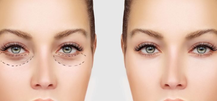 Descubra Como é o Pós-Operatório da Blefaroplastia