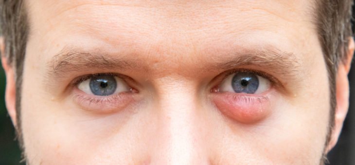 Calázio e máscara facial: o que você precisa saber