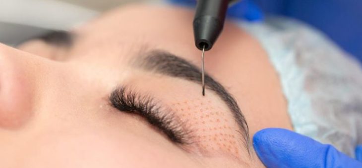 Blefaroplastia sem cortes: o que é? como é feita? Onde fazer?