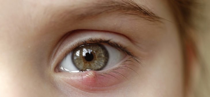 Terçol: o que é? Quais os sintomas? Como tratar?