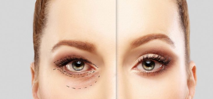 Tudo sobre a Blefaroplastia