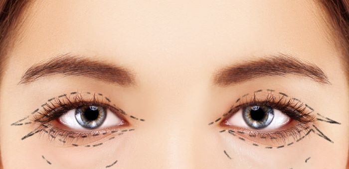 Como funciona o pós-operatório da blefaroplastia?  Tire suas dúvidas