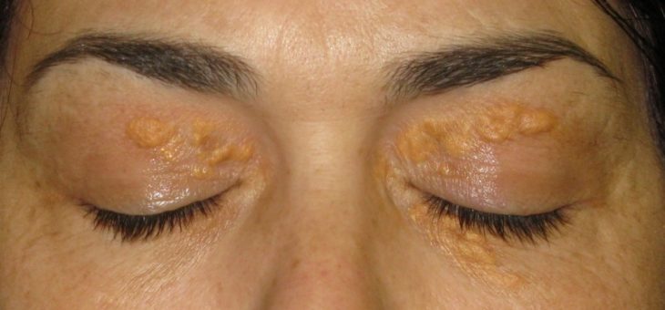 O que é xantelasma? Quais são os sinais? Como é o tratamento?