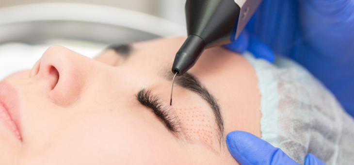 Como é feita a blefaroplastia sem cortes? Como é a recuperação? Onde fazer?